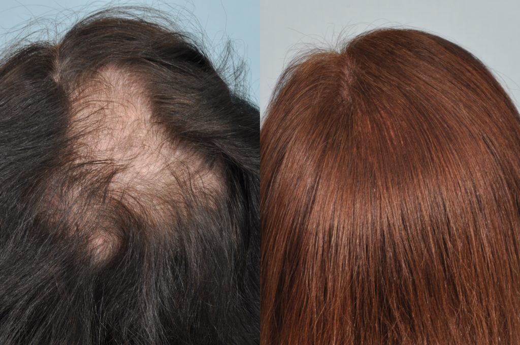 Synthetic Hair Transplant Biofibre Read This Before You Decide