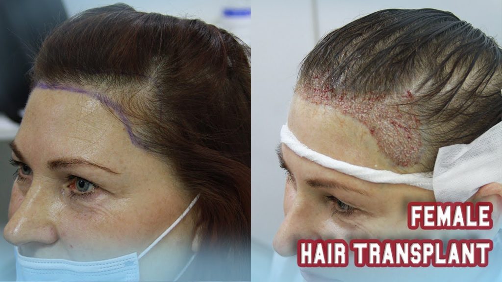 Everything You Should Know About Hair Transplant for Females in Turkey