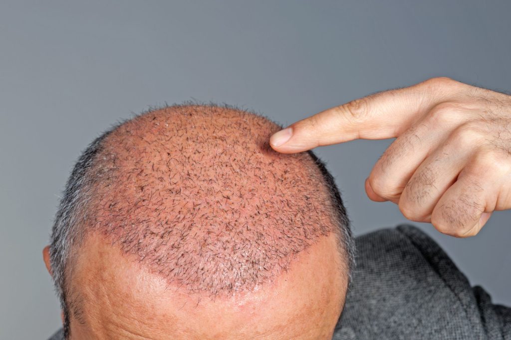Stages of Growth After a Transplant  The Hair Loss Recovery Program